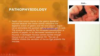 Peptic ulcer Disease  Metro College of Nursing [upl. by Breger523]