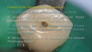 Fiber post removal during endodontic retreatment by Assoc Prof Dr Talal AlNahlawi د طلال النحلاوي [upl. by Adnawot]