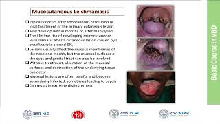 36Leishmaniasis Clinical Features Diagnosis and Management [upl. by Notsej]