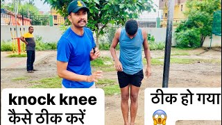 Knock Knee Problem Solution  knock kneeकैसे ठीक करें  knock Knees workout [upl. by Rianon]