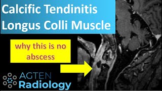 Calcific tendinitis longus colli muscle [upl. by Irtemed930]