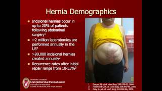 At the Forefront of Hernia Repair [upl. by Gomar]