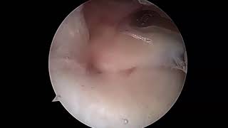 Combined Procedure of Arthroscopic Pullout Medial Meniscal Root Repair From Lateral Tibia [upl. by Maclaine]