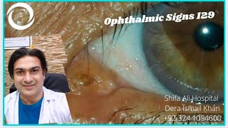 Ophthalmic Signs 129 [upl. by Paco]