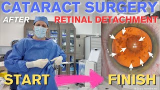 Cataract Surgery after Retinal Detachment  3 Min Polishing  Full Video from Start to Finish [upl. by Mellie]