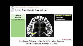 05 Complications Of Local Anesthesia Related To Utilized Technique [upl. by Ayotel795]