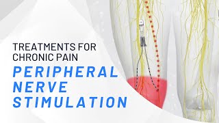 Peripheral Nerve Stimulation  What You Need To Know [upl. by Inajar]