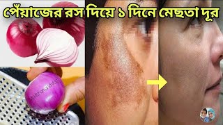 পেঁয়াজের রস এই ভাবে লাগান ১ দিনে মেছতা দূর হবেমুখের মেছতা দূর করার সহজ উপায় [upl. by Yddet443]