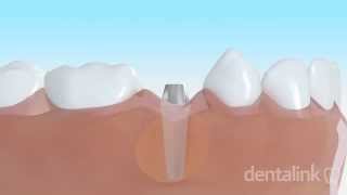 IMPLANTE DENTAL óseo integrado  Video 3D paso a paso [upl. by Glantz]