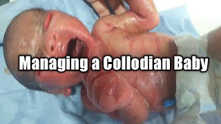 How to manage a Collodian Baby  Mothers Guide [upl. by Acinoreb354]