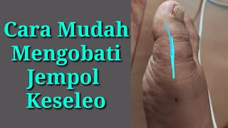 Cara Cepat Mengobati Keseleo Jempol Kaki Gampang Efektif Manjur [upl. by Flagler950]