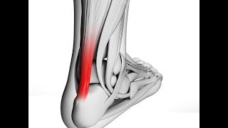 What is Achilles Tendonitis [upl. by Leind]