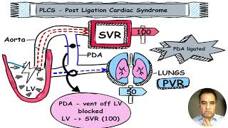 What is Post Ligation Cardiac Syndrome in Neonates [upl. by Karissa]