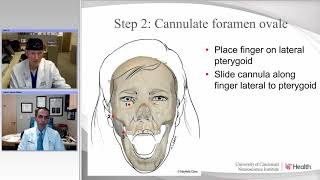 Percutaneous Procedures for Trigeminal Neuralgia Radiofrequency and Balloon Compression Rhizotomy [upl. by Srini568]