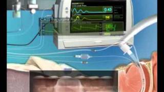 The AnapnoGuard system of Hospitecproduced by Virtual Point [upl. by Ulah]