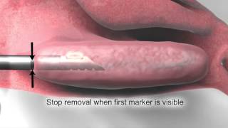 Turbinoplasty  Downtown Los Angeles  LA Sinus amp Allergy Specialists [upl. by Keegan]