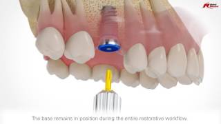 On1 restorative concept  Nobel Biocare [upl. by Llenahs]