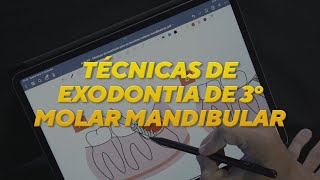 TÉCNICAS DE EXODONTIA para os terceiros molares mandibulares [upl. by Ileane]