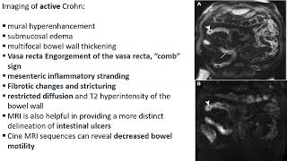 Diffusely Infiltrative Small Bowel Disease dr Sara Tawfiq [upl. by Leggett]