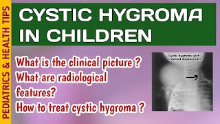 Cystic Hygroma  Symptoms Diagnosis amp Treatment [upl. by Eseeryt]