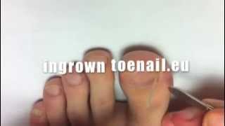 How to apply ingrown toenail treatment brace AT HOME [upl. by Balcke386]