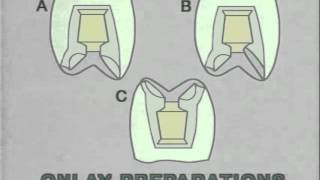 Inlay and onlay variations [upl. by Nedah546]