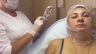 Kabelline live injection for double chin made by Russian clinic  Mediwith Korea [upl. by Emrich961]