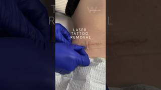 Laser Tattoo Removal with a PFD patch at Wise Med Spa for double the ink removal [upl. by Nance]