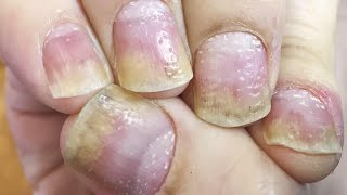 Home Remedies for Nail Psoriasis [upl. by Beard]