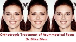 Orthotropics Treatment of Asymmetrical Disproportionate Uneven Faces by Dr MIke Mew [upl. by Robert]