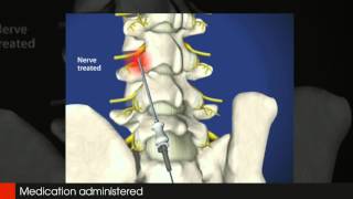 Lumbar Radio Frequency Neurotomy Tampa Pain Physicians 8139611314 [upl. by Adnahs]