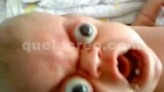 Baby Bug Eyes Rare Disease  Proptosis amp Hydrocephalus [upl. by Levine]