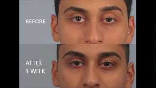 Droopy Eyelid Surgery Review  Dr Brett Kotlus [upl. by Thorley]