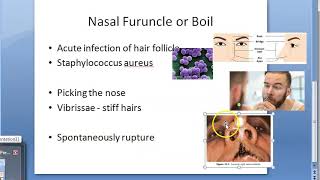 ENT Nasal Furuncle Hair Follicle Furunculosis Nose Boil [upl. by Jake]