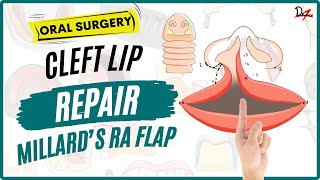 Cleft Lip Repair  Millards Rotation Advancement Flap [upl. by Meghann]