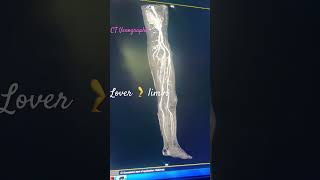 CT scan  Venography lover limb 🦵 [upl. by Drew445]