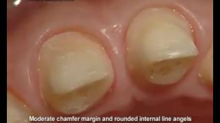 Slefuirea dintilor in vederea aplicarii coroanelor dentareTooth preparation for dental crown [upl. by Petie]