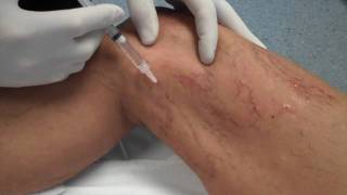 Sclerotherapy  The Vein Centre  Dr Richard Murbach  Treatment for Spider Veins [upl. by Kali724]