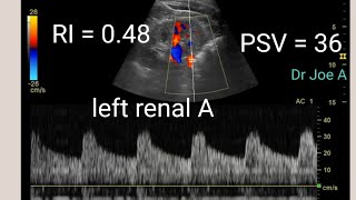 Normal renal Doppler in a hypertensive patient color Doppler ultrasound and spectral Doppler video [upl. by Arec]