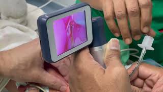 A preterm neonate is intubated using a video laryngoscope [upl. by Yunick]