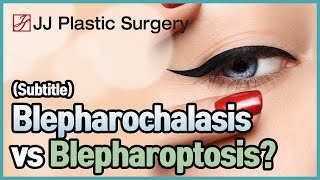 Blepharochalasis vs Blepharoptosis [upl. by Aver479]