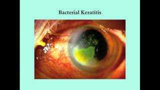 Keratitis  CRASH Medical Review Series [upl. by Lua]