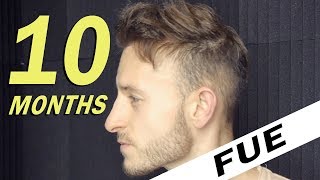 FUE Hair Transplant 10 Months post op Istanbul Turkey [upl. by Hamirak]