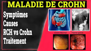 MICI  Maladie de Crohn Symptômes Causes Traitement  Gastrologie Médicale [upl. by Frechette]