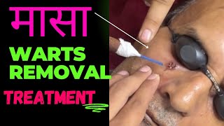 Masse Ko Kaise Hataye  Warts Removal Treatment  Warts on Face [upl. by Palmer]