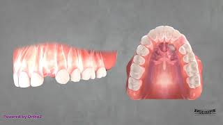 Palatal Impacted Canine Eruption [upl. by Laenej]