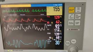 Fibrilación Auricular con RVR Taquicardia Supraventricular  Monitor [upl. by Leonanie]