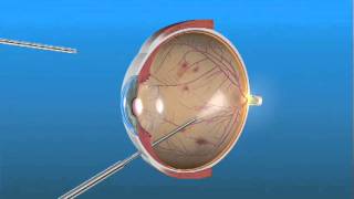 Cirugía de Vitrectomía para Retinopatía Diabética [upl. by Leiahtan]