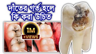 দাঁতের গর্ত হলে কি করবেন  Tooth cavities  Noor Dental JHENAIDAH DentalHealthTips [upl. by Arolf]