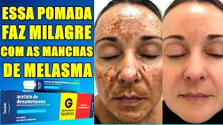 ACABE COM MELASMA E MANCHAS DE ACNE EM POUCOS DIAS COM ESSA POMADA MILAGROSA [upl. by Clarance]